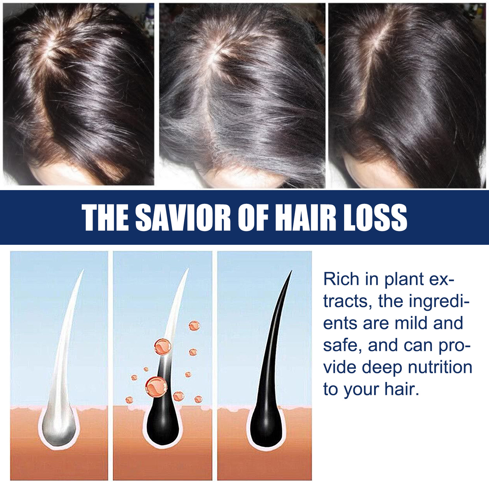 Microneedling and minoxidil combination therapy for hair growth