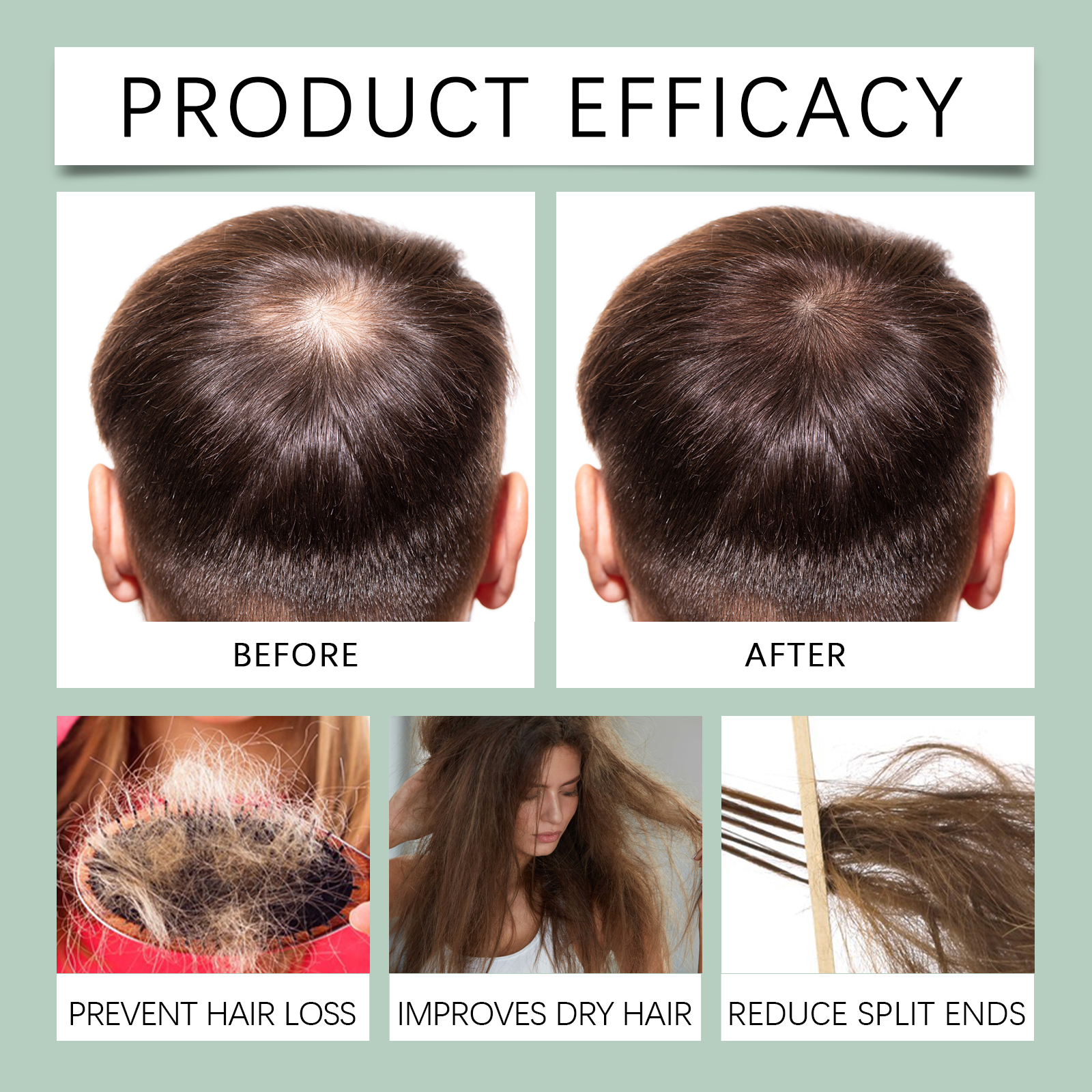 Derma roller six month results crown bald spot coverage improvement