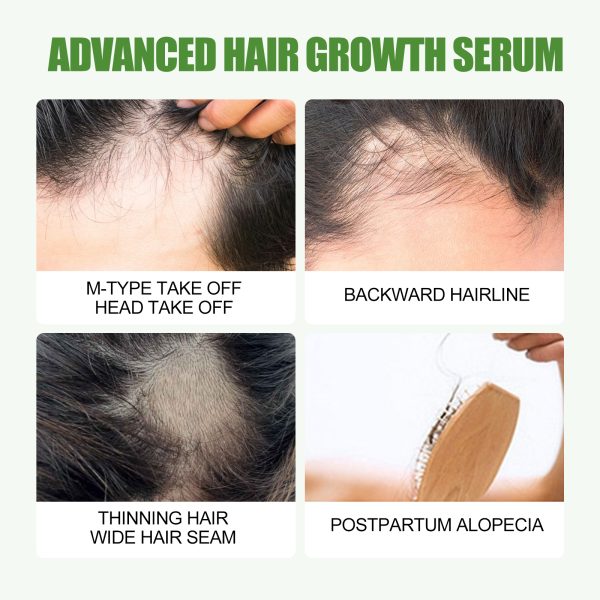 Rosemary Oil Anti Hair Loss Treatment | EELHOE 30ml