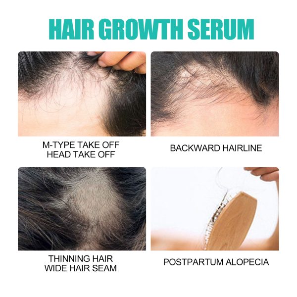 Glycerin & Ginger Anti Hair Loss Treatment | JAYSUING 20ml