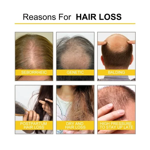 Scalp Treatment | OUHOE 30ml