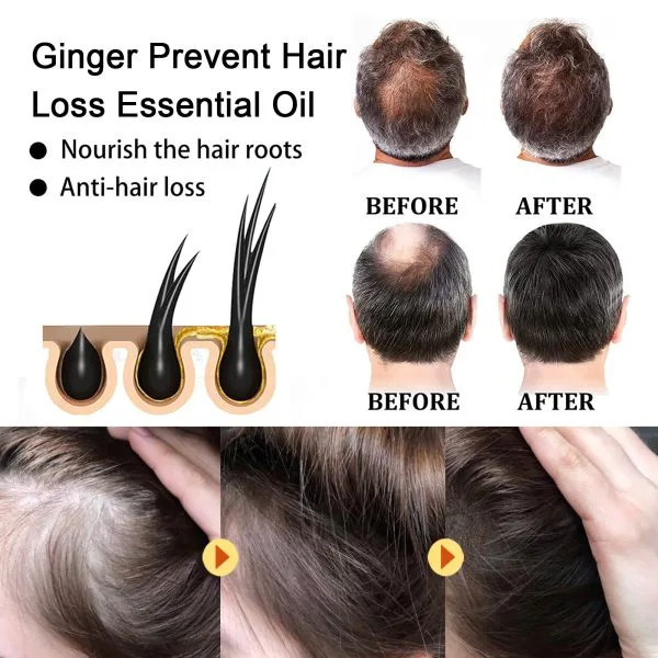 Scalp Treatment | OUHOE 20ml